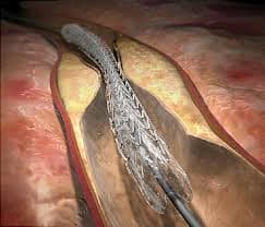 Angioplasty