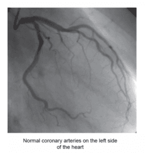 Angiography