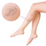 Varicose Vein Clinic